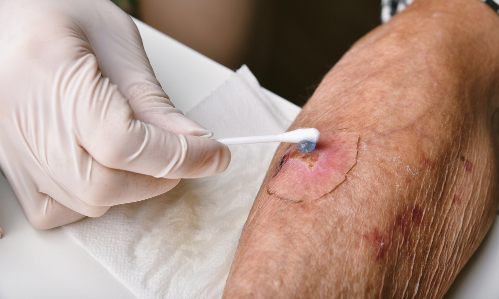 Wound care nurse providing professional wound treatment during a home healthcare visit